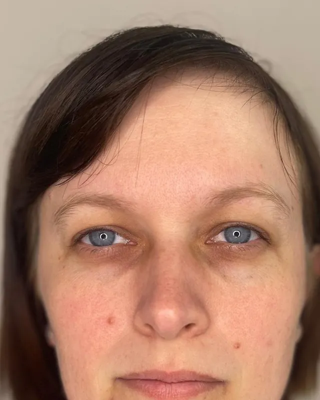 Efter behandling: Bekymringsrynke