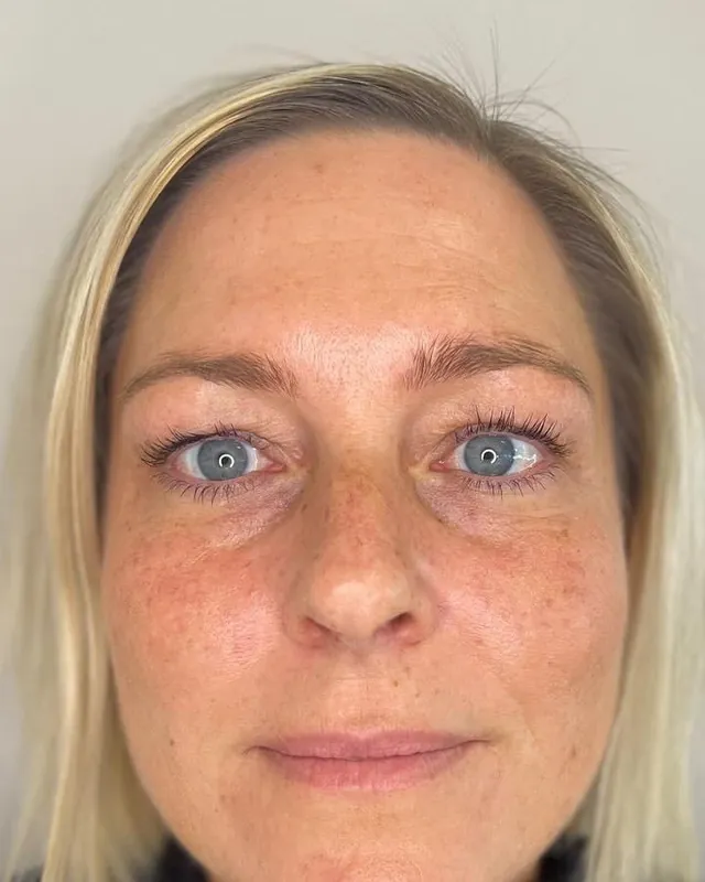 Efter behandling: Bekymringsrynke