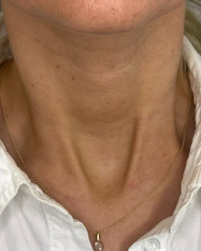 Efter behandling: Hals